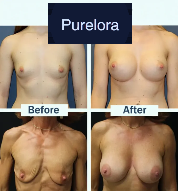【Official Flagship Store】Slimluxes® Targeted Breast Enhancement Advanced Nano Microneedle Patch