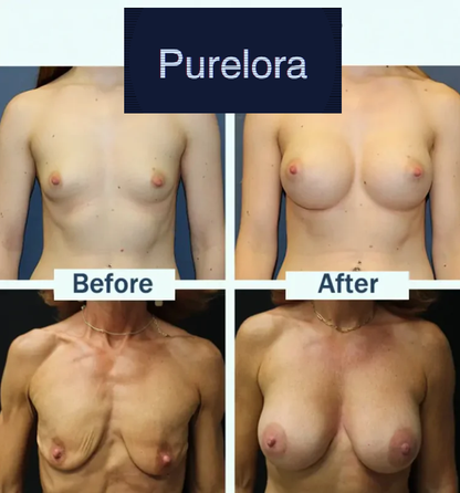 【Official Flagship Store】Slimluxes® Targeted Breast Enhancement Advanced Nano Microneedle Patch